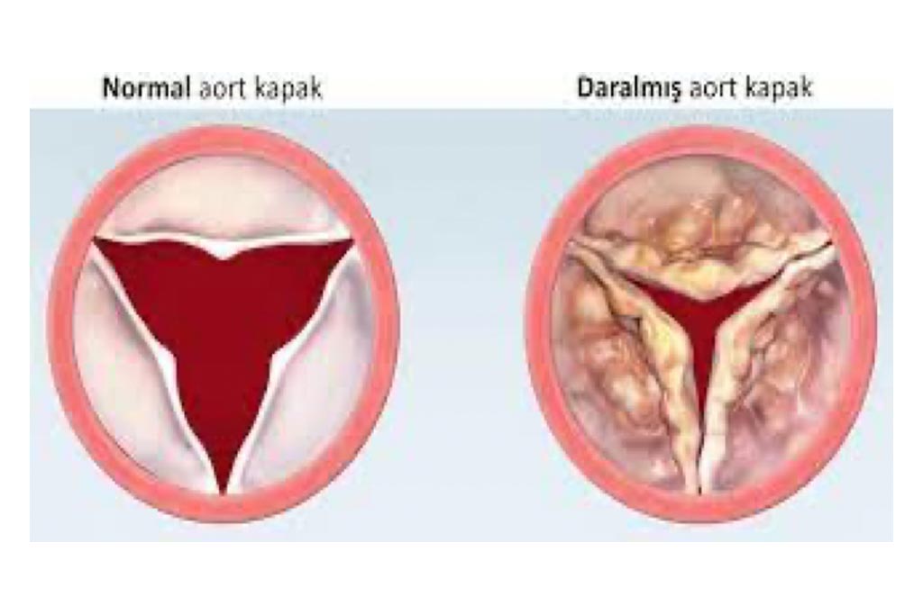 Aortic Stenosis Treatment with Diagnostic Method